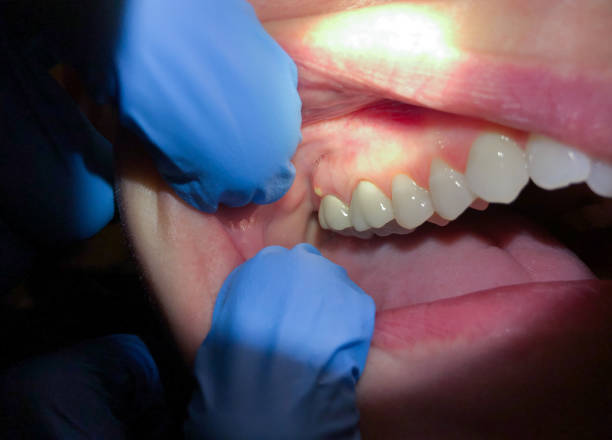 Best Emergency Root Canal Treatment in Cross Lanes, WV